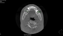 仁医精术 | 8岁儿童颌骨处长“大包” 两年精心治疗拯救恒牙