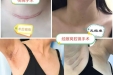 【卓越医疗】郴州首例！经单侧腋窝腔镜完成双侧甲状腺手术——市三医院乳甲外科微创技术再攀新高