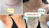 【卓越医疗】郴州首例！经单侧腋窝腔镜完成双侧甲状腺手术——市三医院乳甲外科微创技术再攀新高