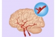 【健康科普】脑子里的“不定时炸弹”，关于动脉瘤您了解多少？