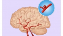 【健康科普】脑子里的“不定时炸弹”，关于动脉瘤您了解多少？