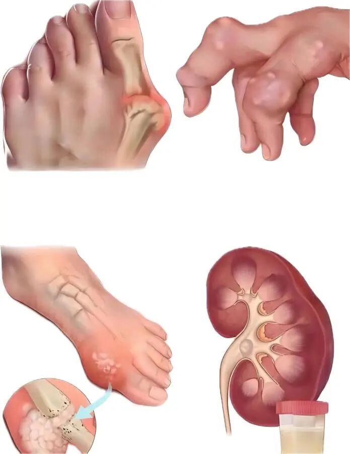 尿酸科普2.jpg