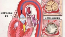 【健康科普】警惕“心门”堵塞！早筛早治是关键